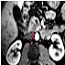 Enhanced MRI detects smaller pancreatic tumours