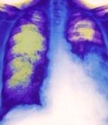 COPD Lungs