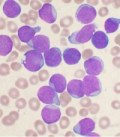 stained-leukemia-cells